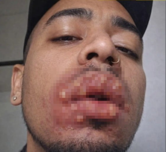 Beijo em festa termina em caso médico grave e gera alerta sobre cuidados com a saúde