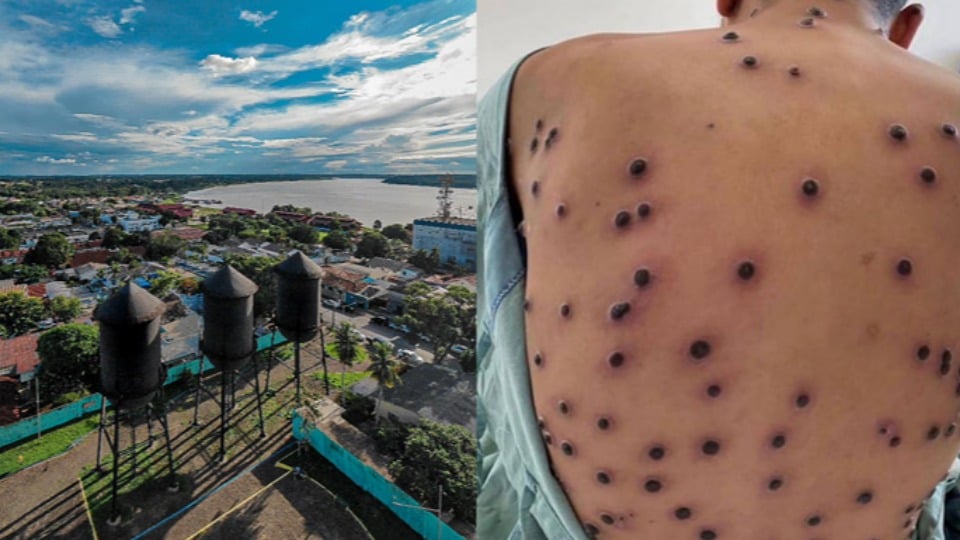 Quatro casos de Mpox já foram confirmados em Rondônia