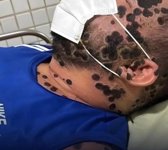 Brasil ultrapassa 60 casos confirmados de Mpox e Ministério da Saúde reforça monitoramento