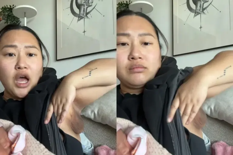 Após parto, mulher desenvolve terceiro seio na axila