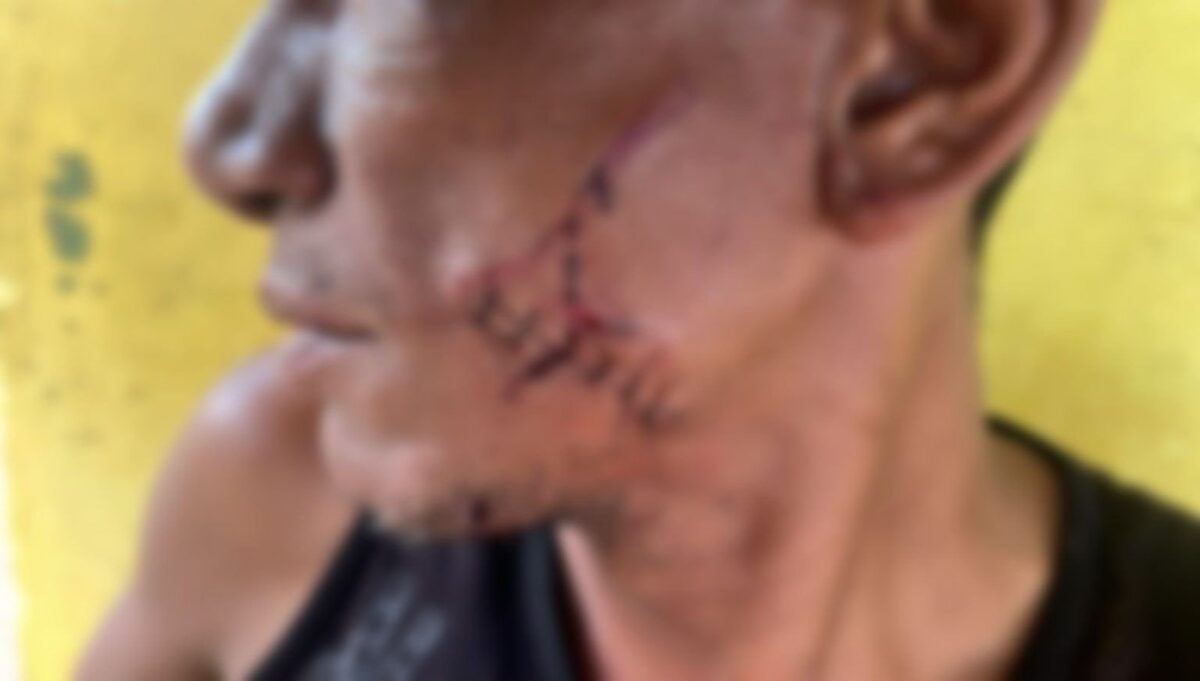Homem fica com ferimento profundo no rosto após ser atingido com garrafa