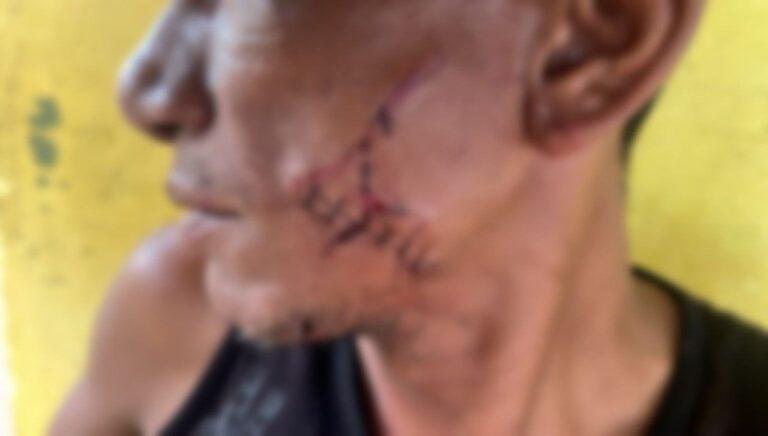 Homem fica com corte profundo no rosto após ser atingido com garrafa durante briga no Acre