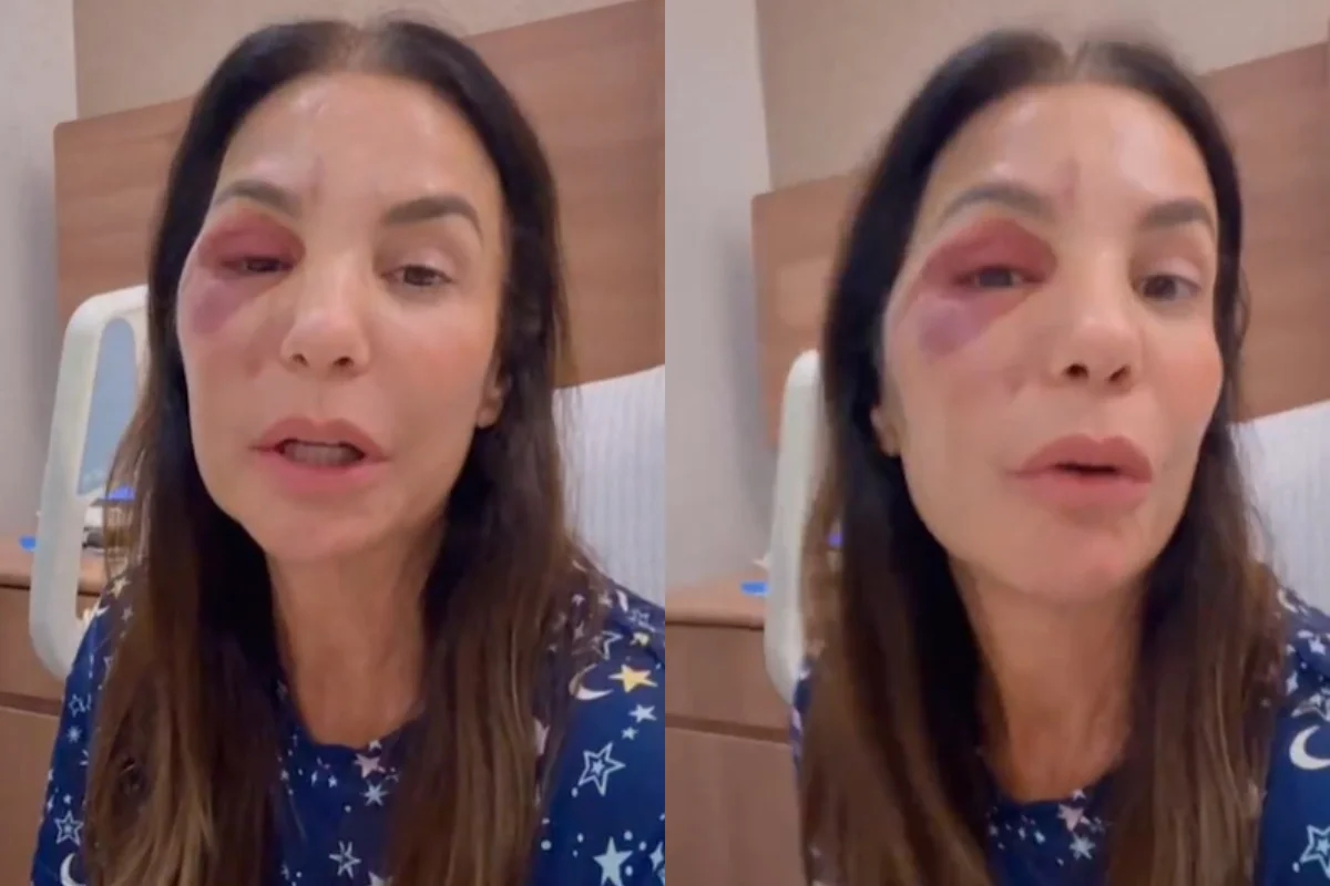 Ivete Sangalo atualiza estado de saúde após cirurgia facial e detalha uso de titânio
