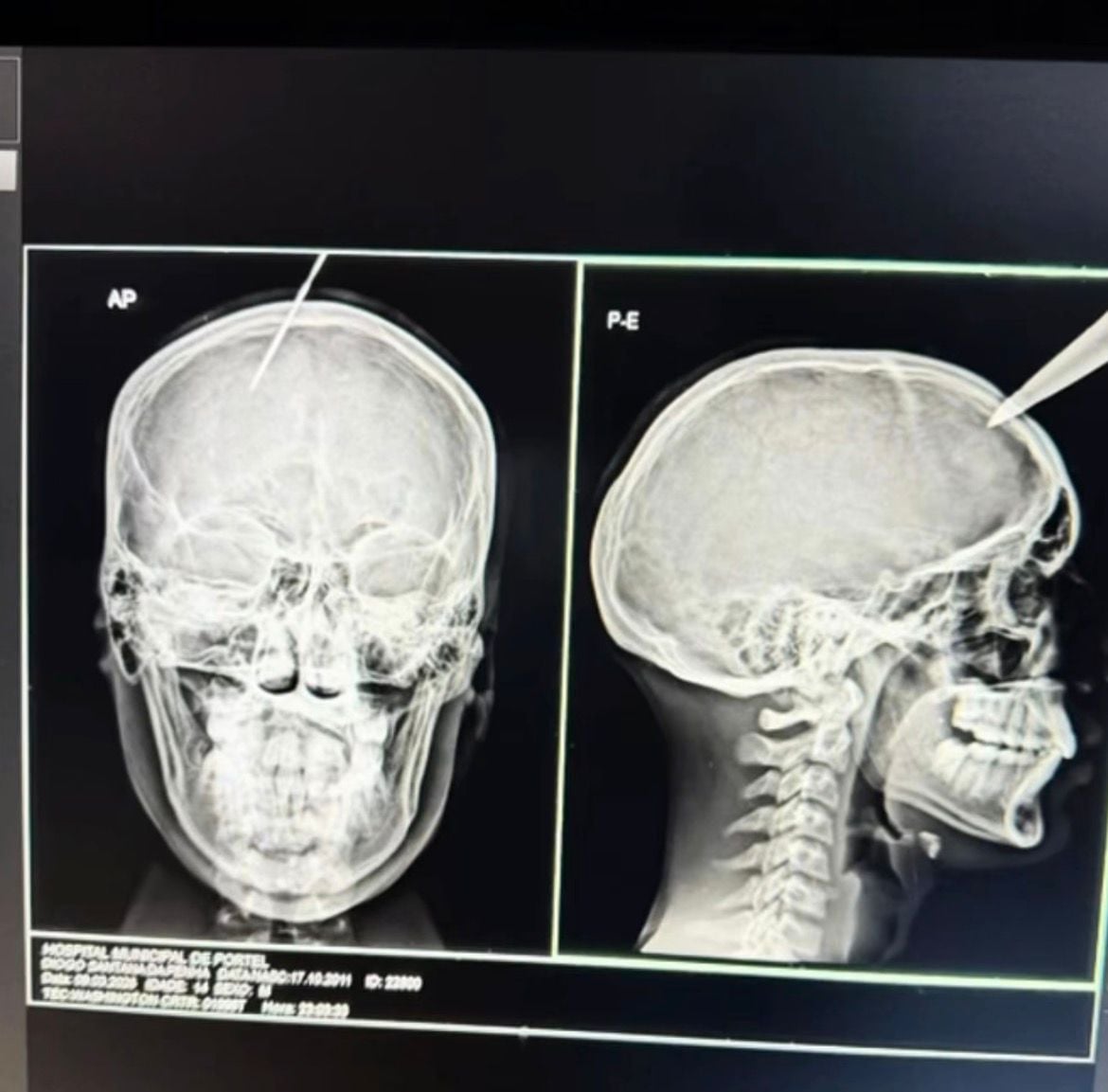 Adolescente de 14 anos é atendido com faca cravada na cabeça após briga entre irmãos