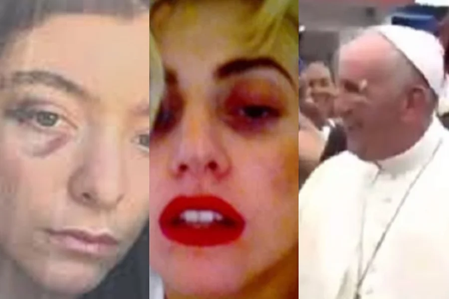 : Ivete Sangalo faz live após cirurgia e explica hematoma no rosto.