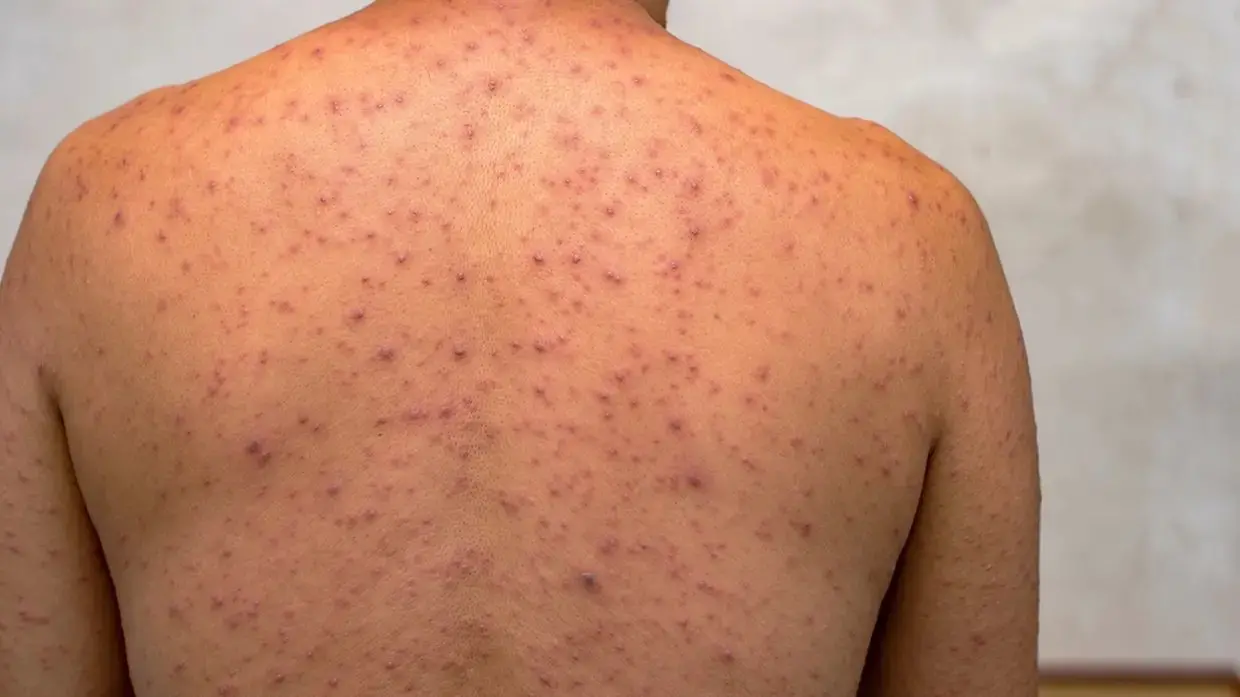 Acre confirma primeiro caso de Mpox no interior