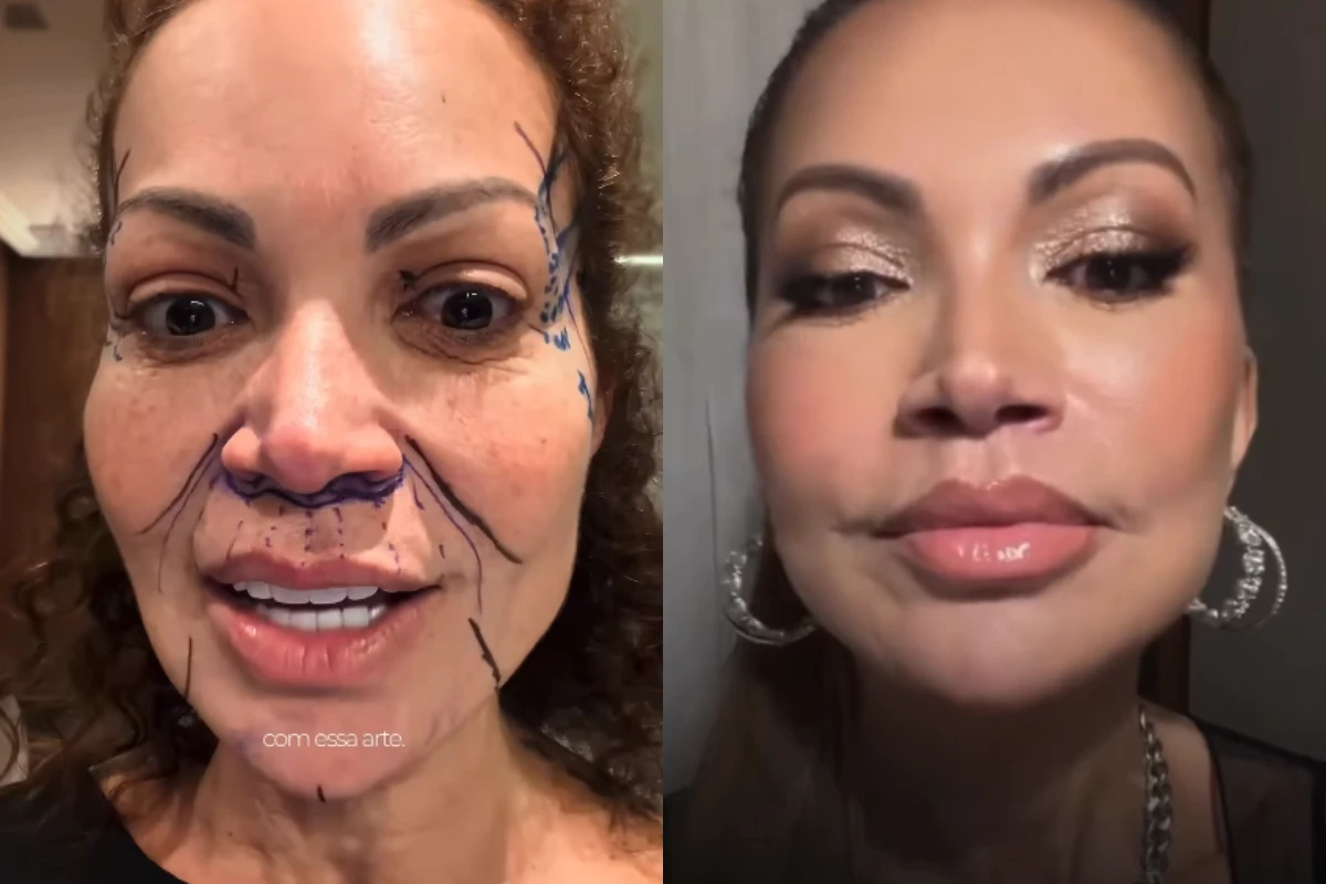 Solange Almeida mostra resultado de lifting facial