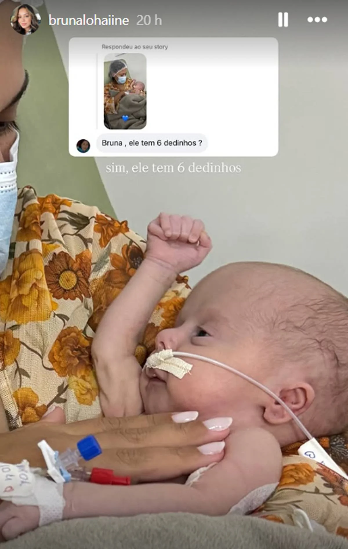 bruna lohaine revela que filho nasceu com alteracao genetica2