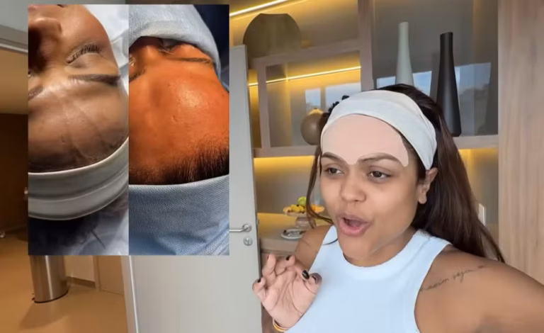 Camila Loures remove veia saltada e médicos alertam