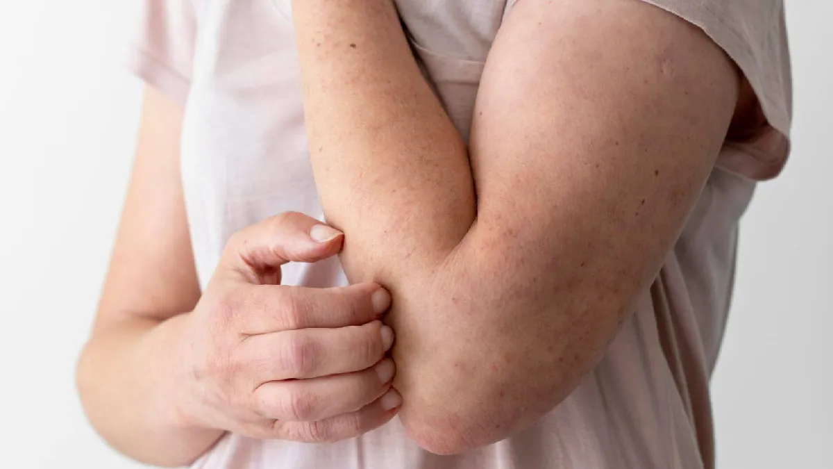 Hanseniase Sintomas Tratamentos E Tudo O Que Voce Precisa Saber