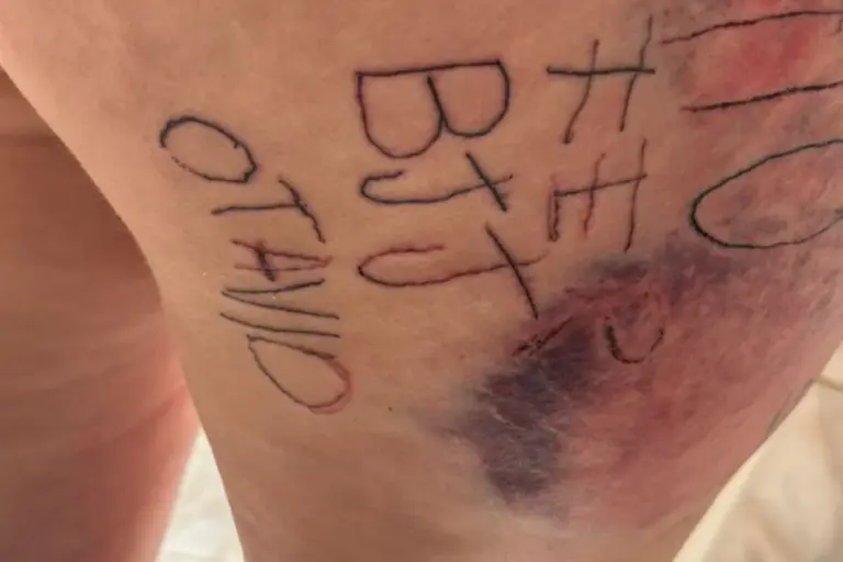 Um caso de violência doméstica com requintes de tortura chocou a região central de Itapetininga, no interior de São Paulo. Um homem de 32 anos foi preso em flagrante — prisão esta já convertida em preventiva pela Justiça — após sua companheira, de 28 anos, conseguir fugir de um cativeiro onde era submetida a agressões brutais e mutilações.