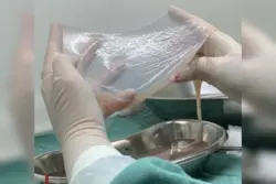 SUS amplia uso de tecido amniótico para tratar pacientes com diabetes