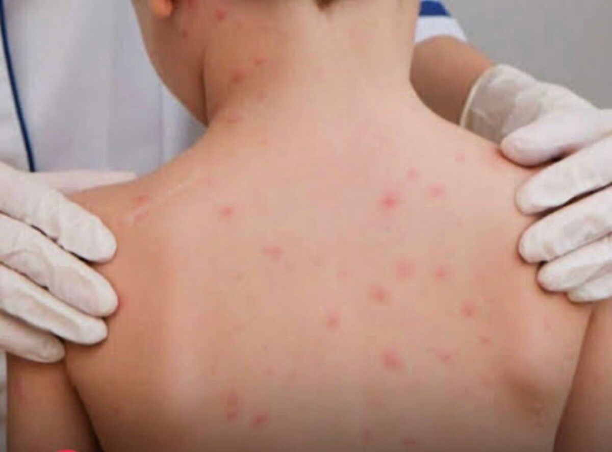 Sena Madureira reforça vacinação contra meningite após caso registrado no Acre