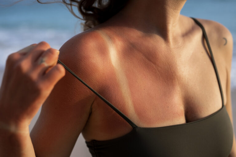 Sol forte no Acre acelera sinais da idade e preocupa dermatologistas