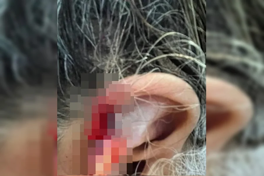 Neto arranca e engole pedaço da orelha da avó de 73 anos Neto arranca e engole pedaço da orelha da avó de 73 anos