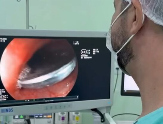 Criança de 3 anos engole moeda e passa por procedimento de urgência Criança de 3 anos engole moeda e passa por procedimento de urgência