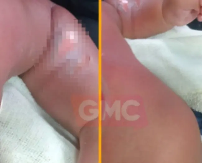 Bebê de 9 meses sofre queimaduras em creche e passa por cirurgia