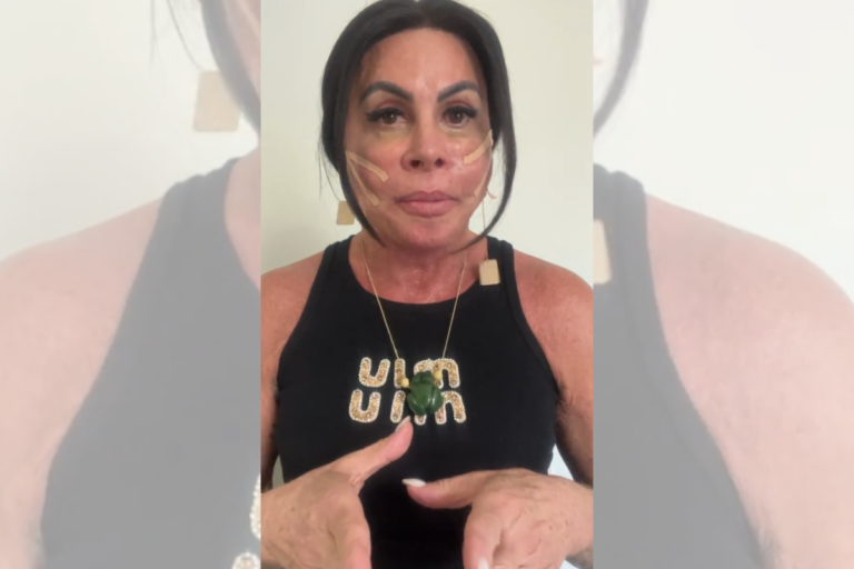 Gretchen aplica fios de sustentação no rosto; médica explica