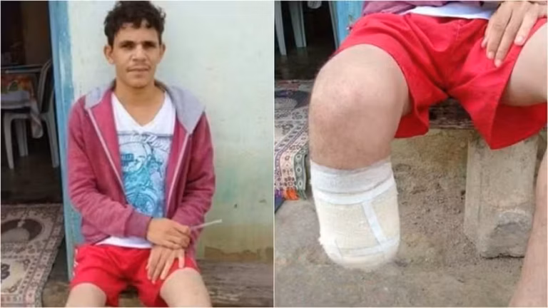 Homem corta o próprio pé para tentar receber R$ 1,5 milhão; entenda