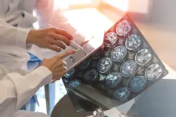 Ministério da Saúde incorpora medicamento ao SUS para tratamento de ELA