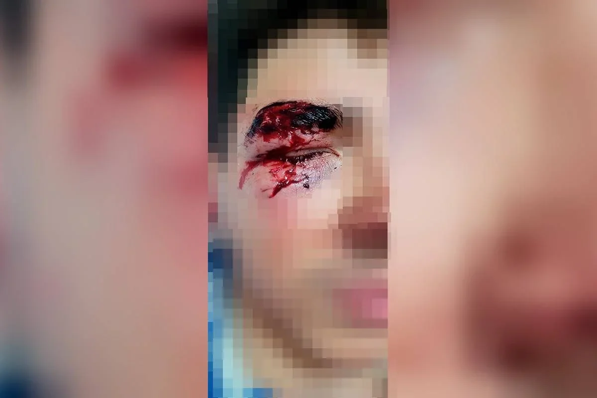 Jovem fica ferido após ser atingido por soco de morador de rua e ter óculos quebrados
