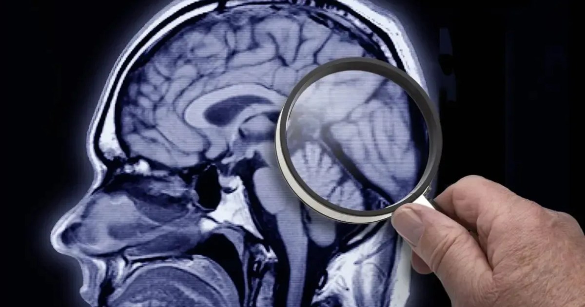 Estudo identifica proteína que acelera desenvolvimento do Alzheimer Estudo identifica proteína que acelera desenvolvimento do Alzheimer