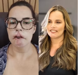 Após perder o lábio por uso de PMMA, influencer diz: “Eu venci”