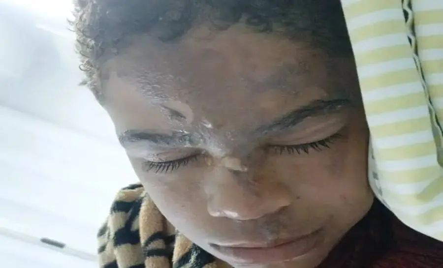 Explosão de panela de pressão deixa jovem em estado grave e família pede ajuda