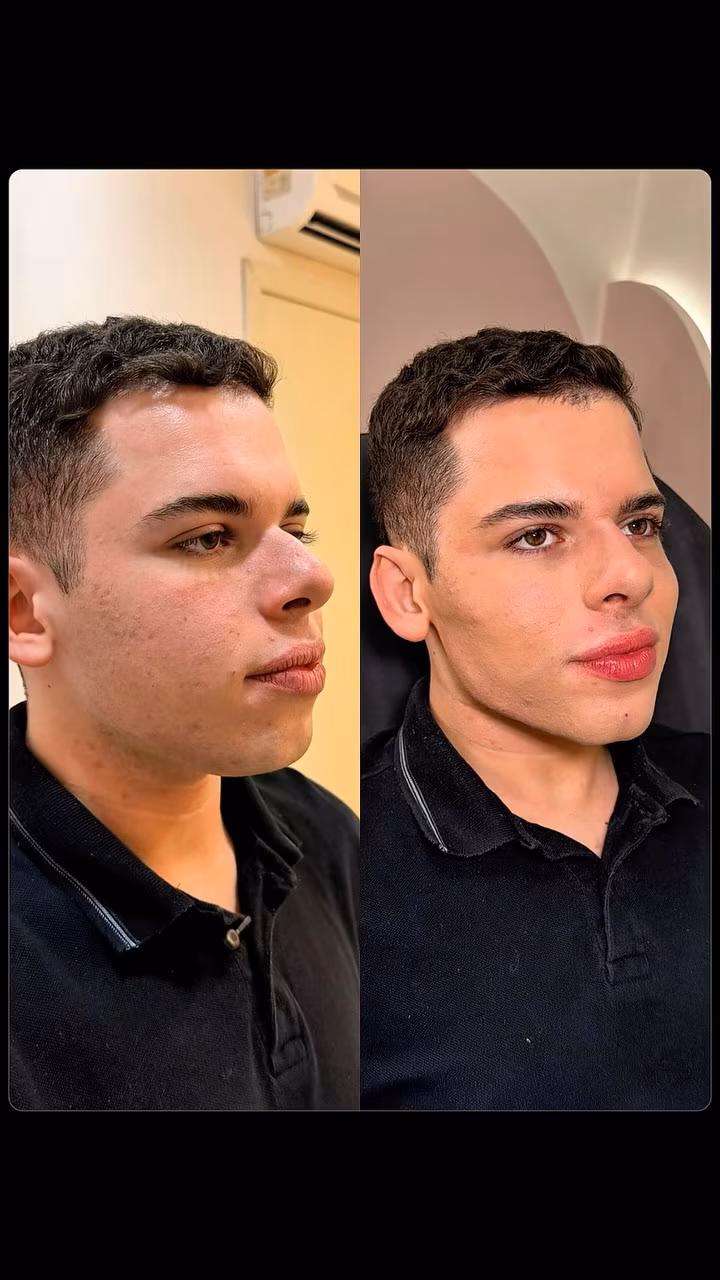 Influenciador acreano surpreende com nova transformação após harmonização facial